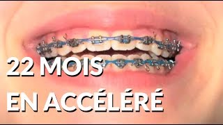 22 mois de bagues en 2 minutes - Appareil-dentaire.info