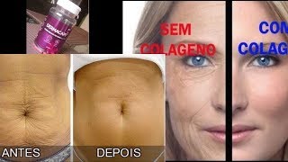 Dermacaps Colageno Funciona - Antes e Depois