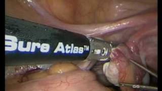 Total Laparoscopic Hysterectomy - The 'DRS' Technique