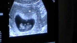 10 week ultrasound
