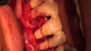 Laser e Microscopio in Parodontologia Dott Signorini Maurizio