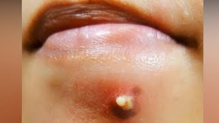 Best Cystic Acne & Top Pimple Pops on Instagram 2018