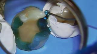 indirect composite retoration