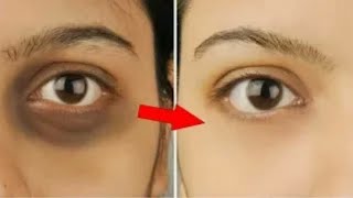চোখের নিচের কালো দাগ দূর করুন নিমিষেই