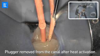 Superendo Alpha2 & beta - Obturation Device (HotTip & HotShot)