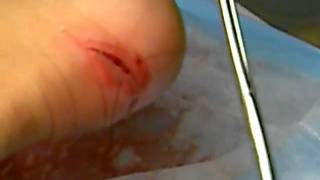 Morgan's Foot Adventure pt.7- Needle and Thread