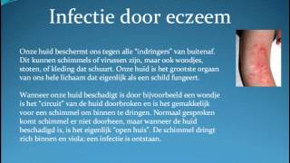 Eczeem en infecties