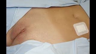 LABIOPLASTIKA MALIH I LIPOFILING VELIKIH STIDNIH USANA U KLINICI BARBEL