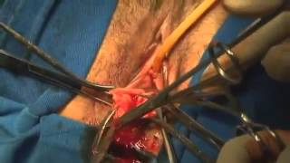 on ve  arxa vaginoperineoplastika     Anterior and posterior colpoperineoplasty