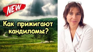 Как прижигают кондиломы на головке