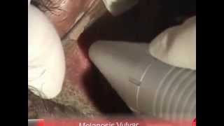Blanqueamiento vaginal con Láser.