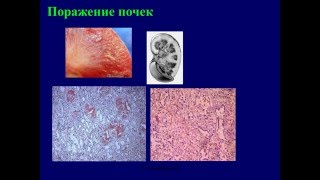 Миеломная болезнь болезнь Рустицкого Калера