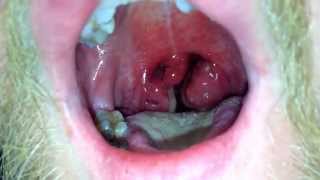 Very sore throat.