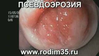 Эрозия шейки матки. Цервикоскопия и гистероскопия