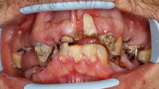 Jak odbudować takie zęby? Neglected teeth reconstruction with dental implants Ankylos Friadent