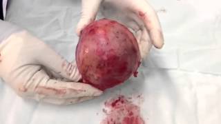 Miomas intramurales