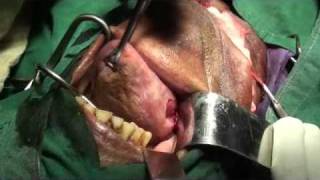 Tongue resection - Hemiglossectomy for youtube