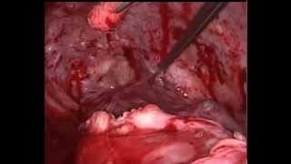Эмпиема плевры, панцирное легкое. Торакоскопия. Thoracoscopic decortications of lung