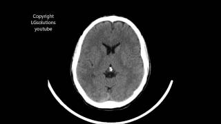 CT scan brain / head without inject oral contrast philips brilliance 64 slice 1920x1080 resolution