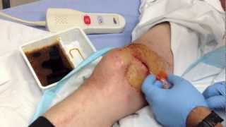 Knee Laceration