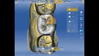 Cerec 4.03 Le Masque Pré-opératoire : Une astuce méconnue   Dr Jacques Raynal