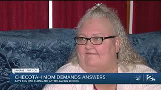 Mom pulls son from school after she says she found cigarette burn on his arm