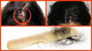 How to Stop Hair Fall & Get Faster Hair Growth/get long thick healthy hair/3 best remedy