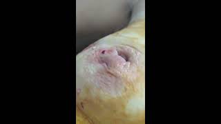 Breast Abscess/мастит субареолярный. операция.