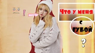 ЧТО С МОЕЙ ГУБОЙ!?Капелярная гемангиома. МОЙ ИЗЪЯН || SCAR.ШРАМ.