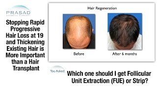 Why FUE or FUT Hair Transplants Don't Prevent Hair Loss, and Hair Loss Management without Surgery