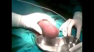 Bilateral Hydrocelectomy Part 1 - Dr Narotam Dewan